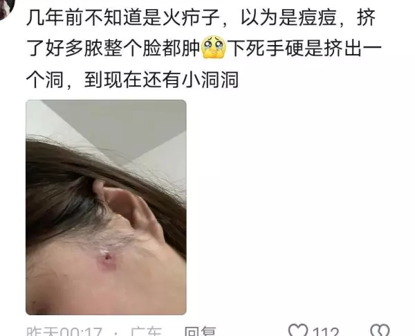 火夹子疙瘩是什么导致的(17)
