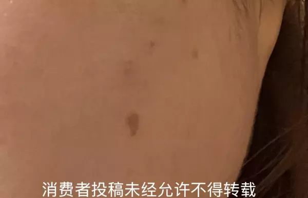 爱尔菲琳溶脂针经过国家批准啦吗(14)