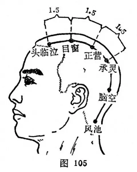 目窗穴在哪个位置(1)