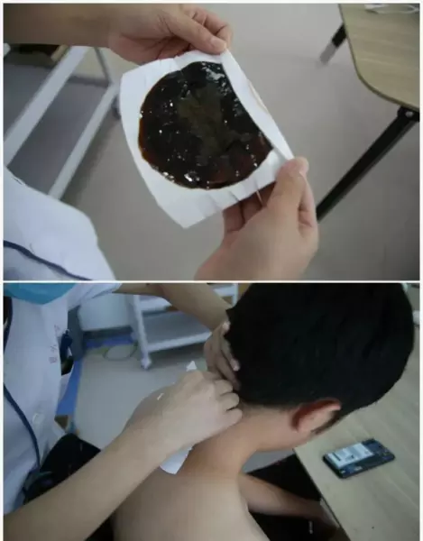 李大华膏药管用吗(2)