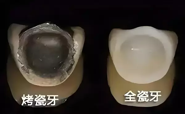 美晶瓷全瓷牙是哪国的(3)