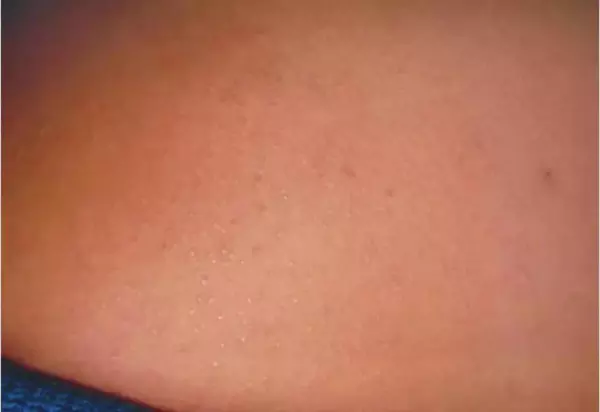 光泽苔藓是什么原因引起的(2)